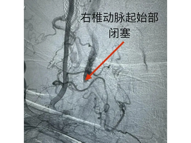 銅川市首例椎動(dòng)脈慢性閉塞開通術(shù)成功
