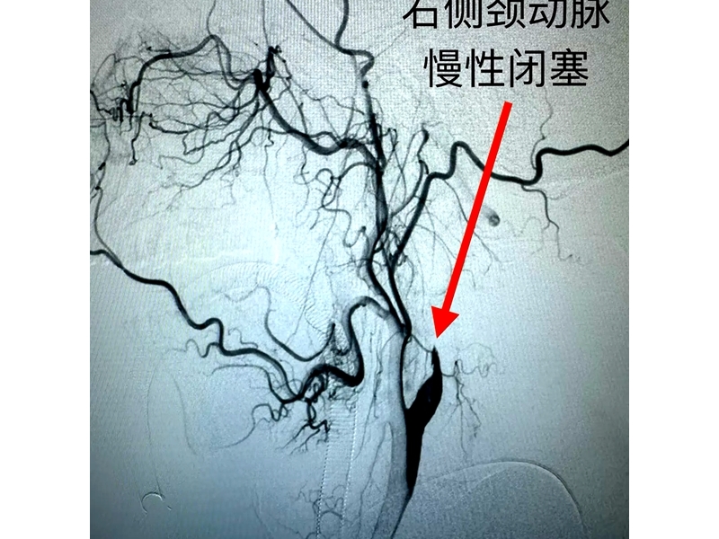銅川礦務(wù)局中心醫(yī)院成功開展首例右側(cè)頸內(nèi)動(dòng)脈慢性閉塞開通術(shù) ...